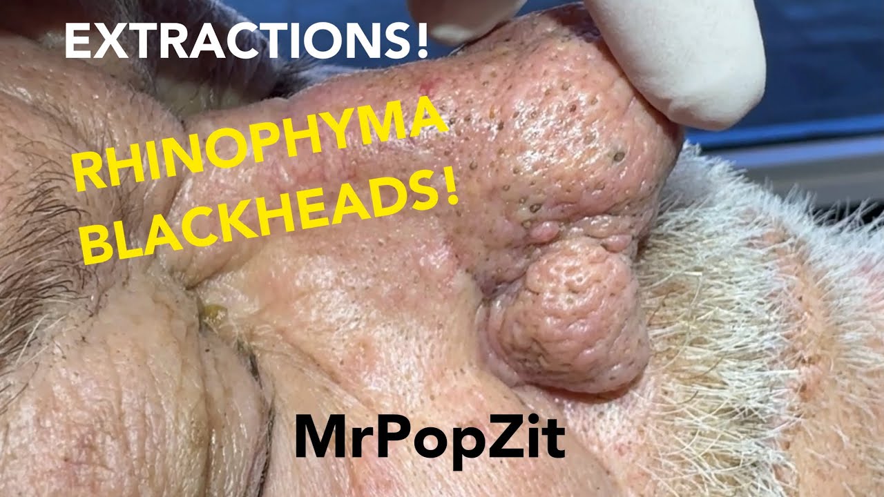 See the blackhead that ALMOST defeats Mr. PopZit! Have you ever seen a blackhead with a hooked bottom? Mr. PopZit 301026