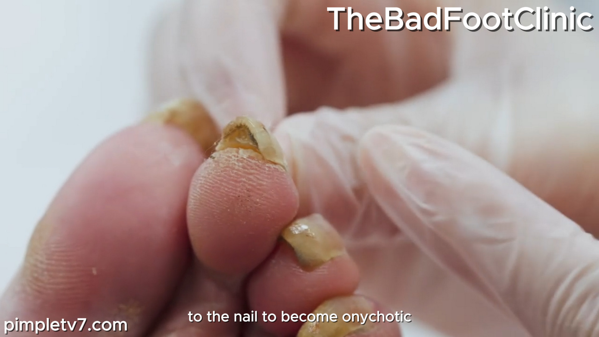 Sharon’s smelly feet ‘smell like an open sewer,’ according to her long-suffering husband. TheBadFootClinic 201026