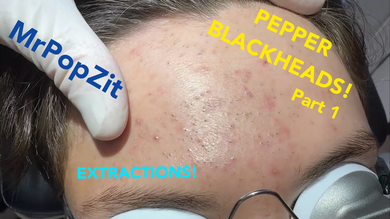 So many blackheads! 22 minutes of just the pop! See his transformation. Black pepper pore plugs! Mr. PopZit 271026