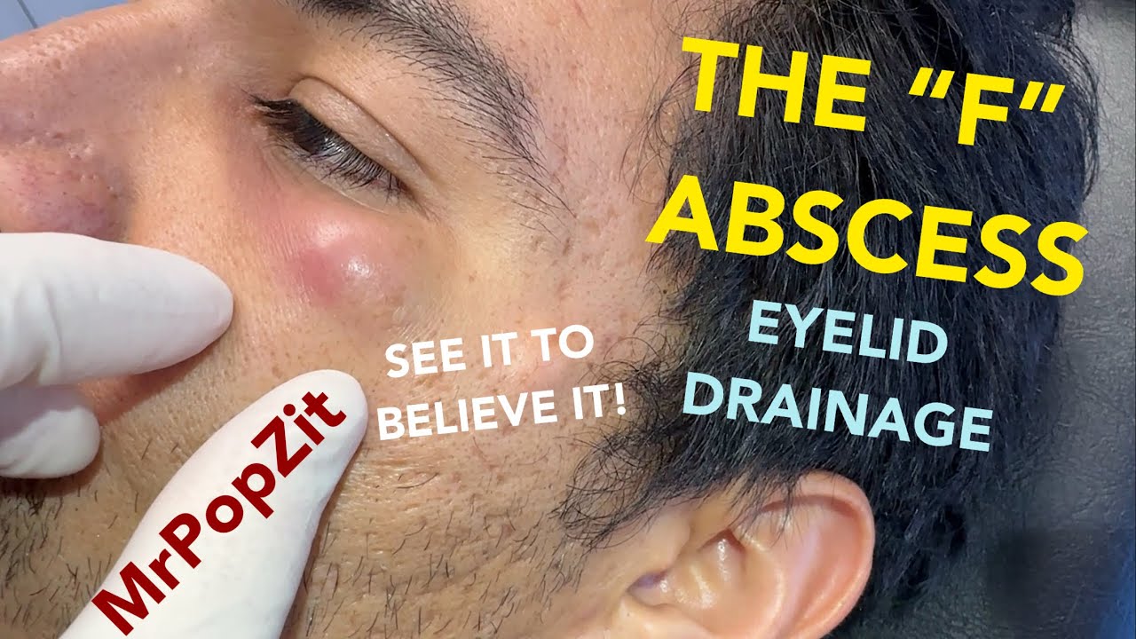 The abscess drainage spells the letter “F”; you have to see it to believe it! Eyelid abscess drained. Mr. PopZit 291026