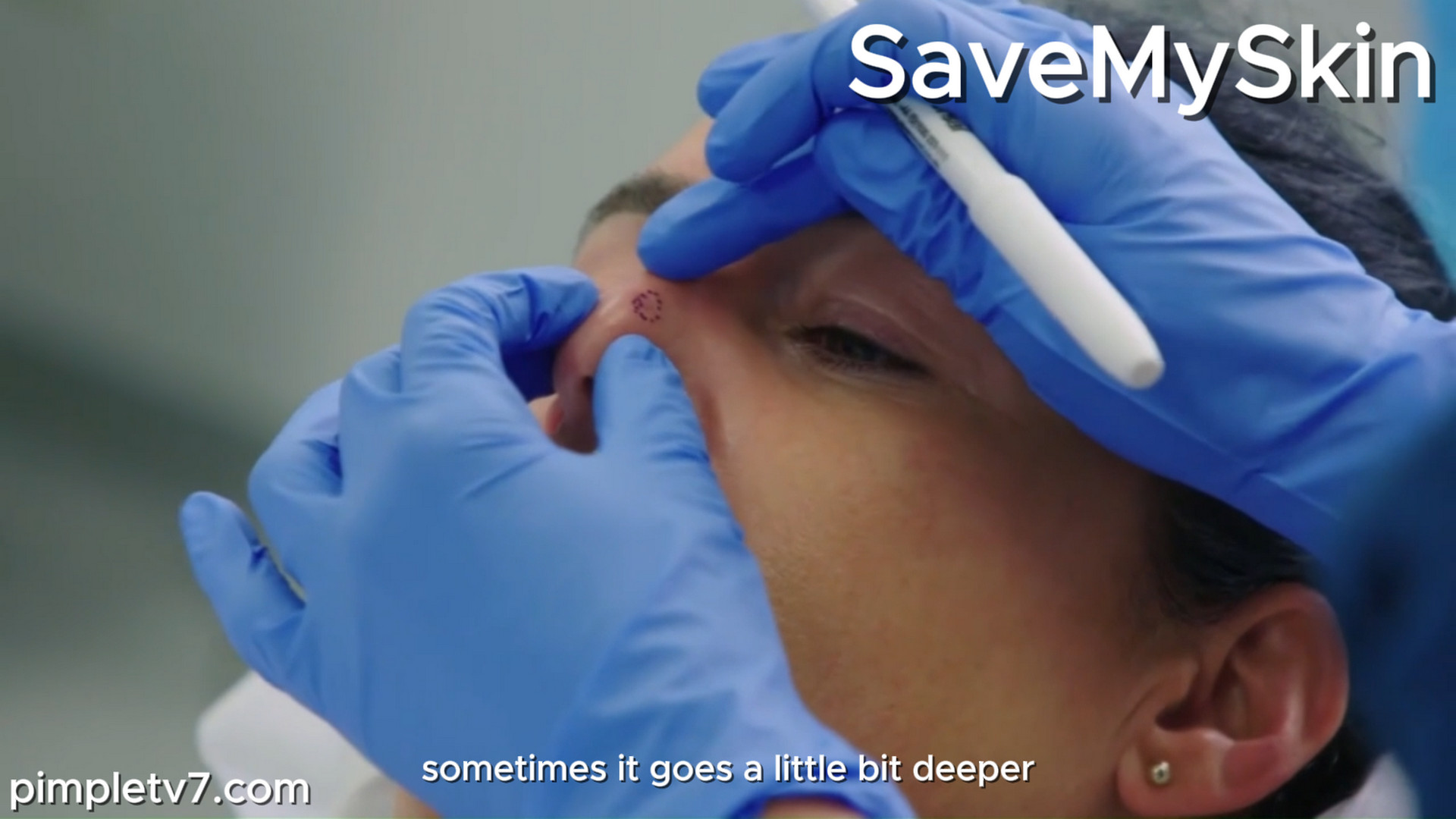 The growth on Traceyleanne’s nose is cause for concern. SaveMySkin 161026