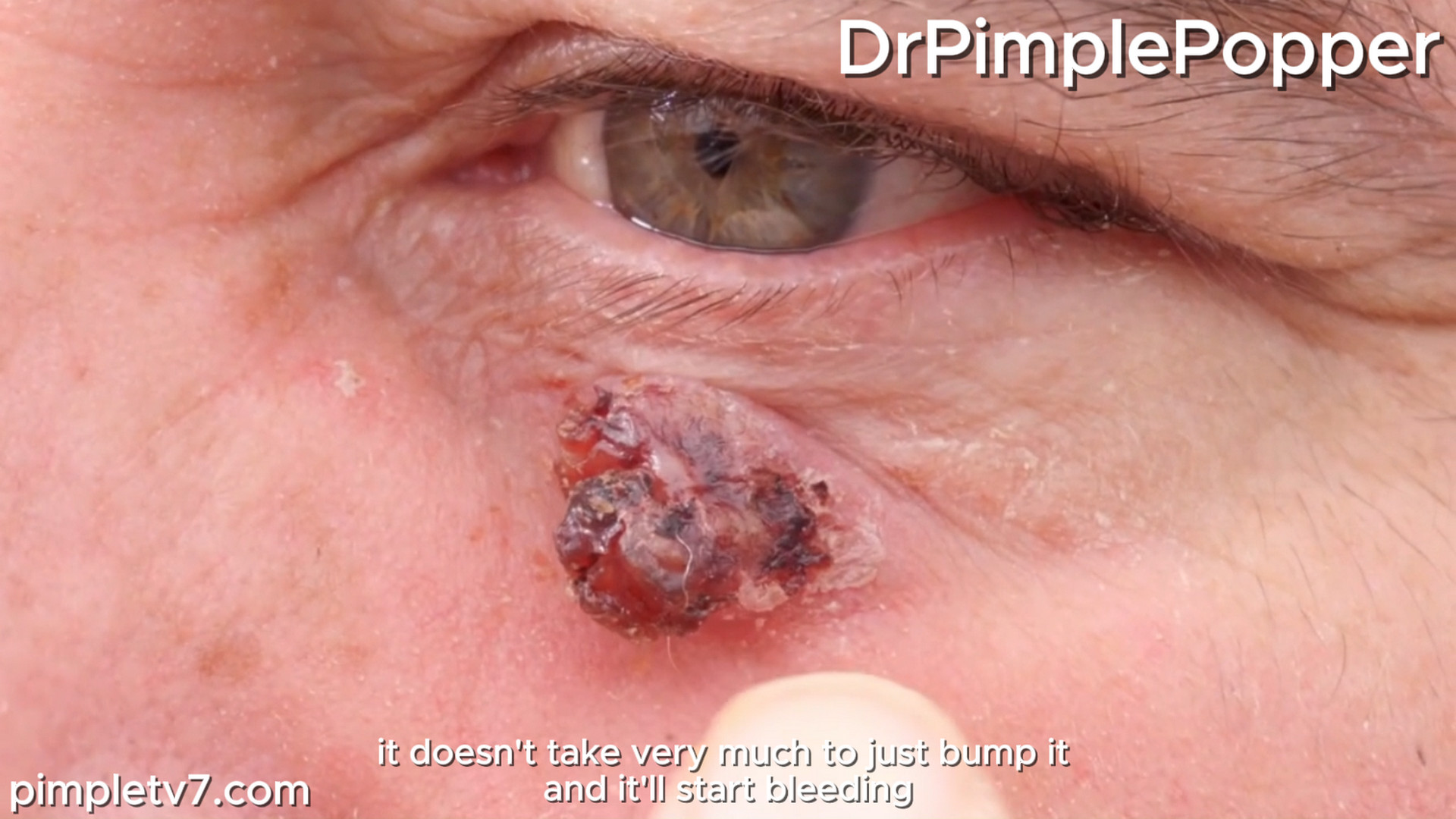 The mysterious bump on James’ cheek loves to bleed. Dr. Pimple Popper 221026