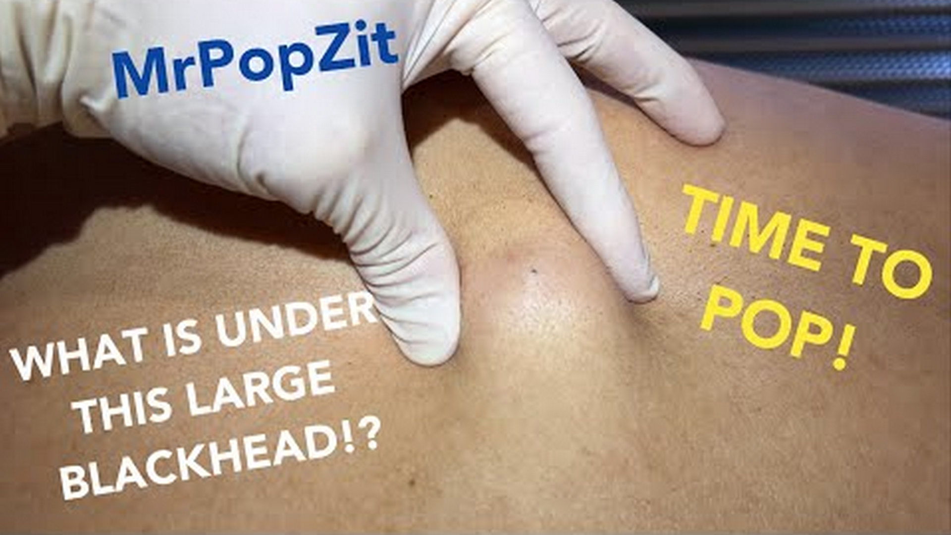 The total flake cyst. See the Fluffy POP! What has grown under that blackhead for all these years! Mr. PopZit 251026