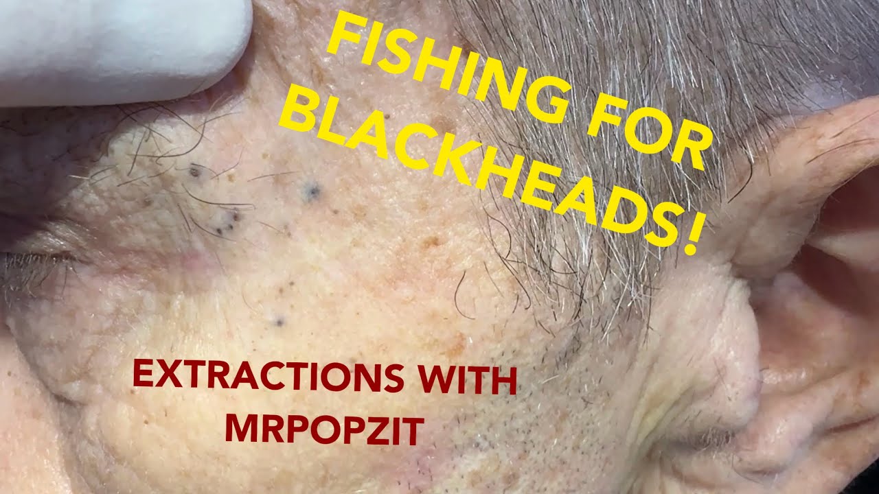 This one has it all! Blackheads, whiteheads, and a bonus steatocystoma! See how I change it up! Mr. PopZit 301026
