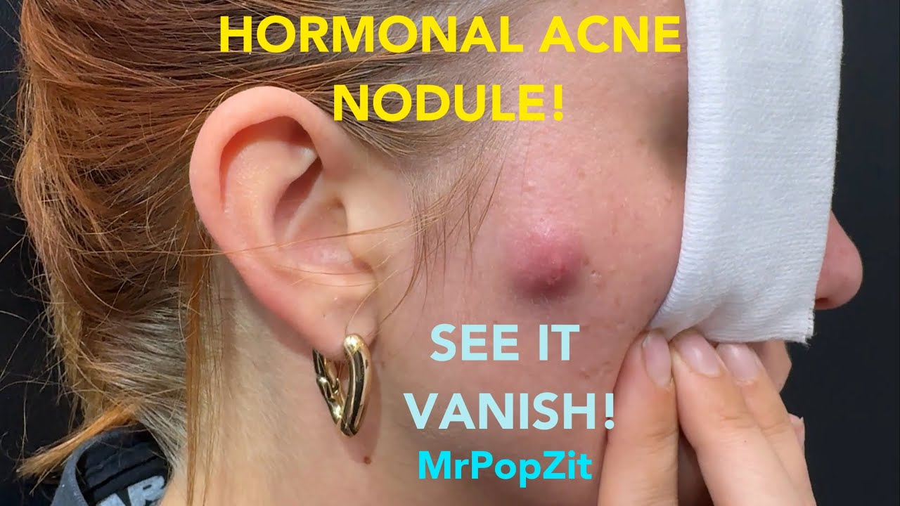 Very full hormonal acne pocket of Purulence!! I drain it. Instant relief and resolved in 48 hours! Mr. PopZit 261026