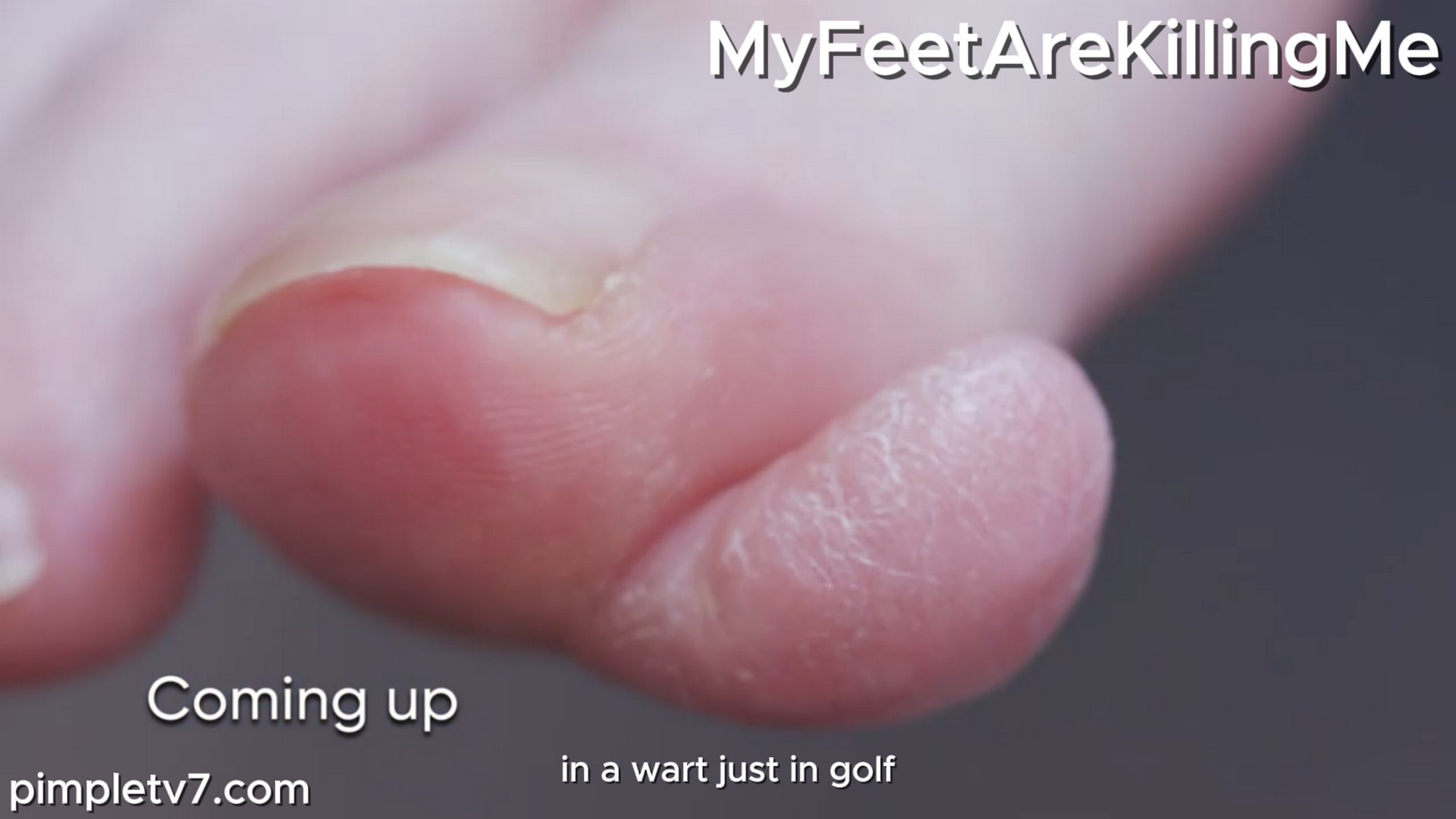 What Dr. Brad’s patient thinks is just a giant wart could be something much more dangerous. MyFeetAreKillingMe 301026