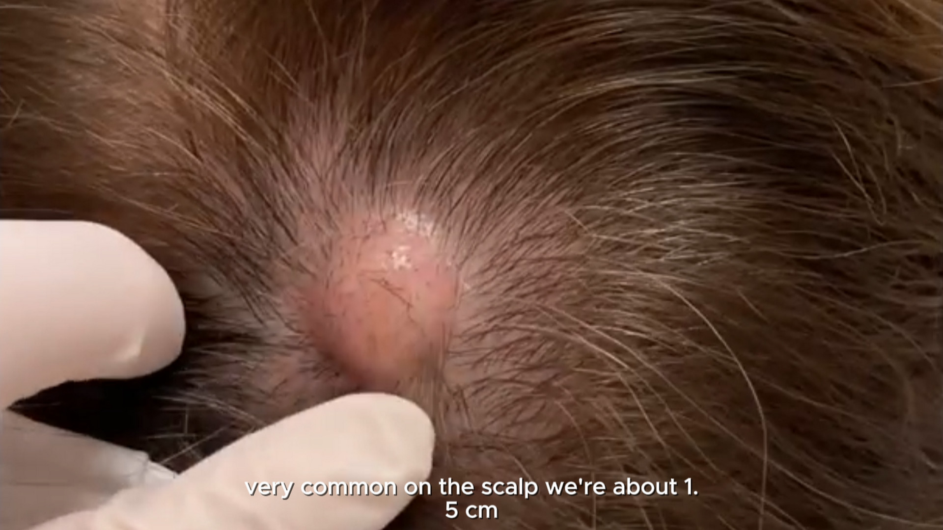 Yellow string Pilar Cyst. Firm cyst on scalp causing hair loss. Yellow pasty contents. MrPopZit 101026